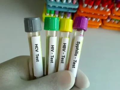 TRIPLE H (3H) PROFILE TEST (HIV, HBSAG, HCV)