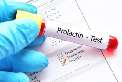 Serum Prolactin Test